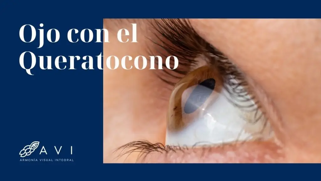 Queratocono: cómo identificarlo a tiempo y opciones de tratamiento